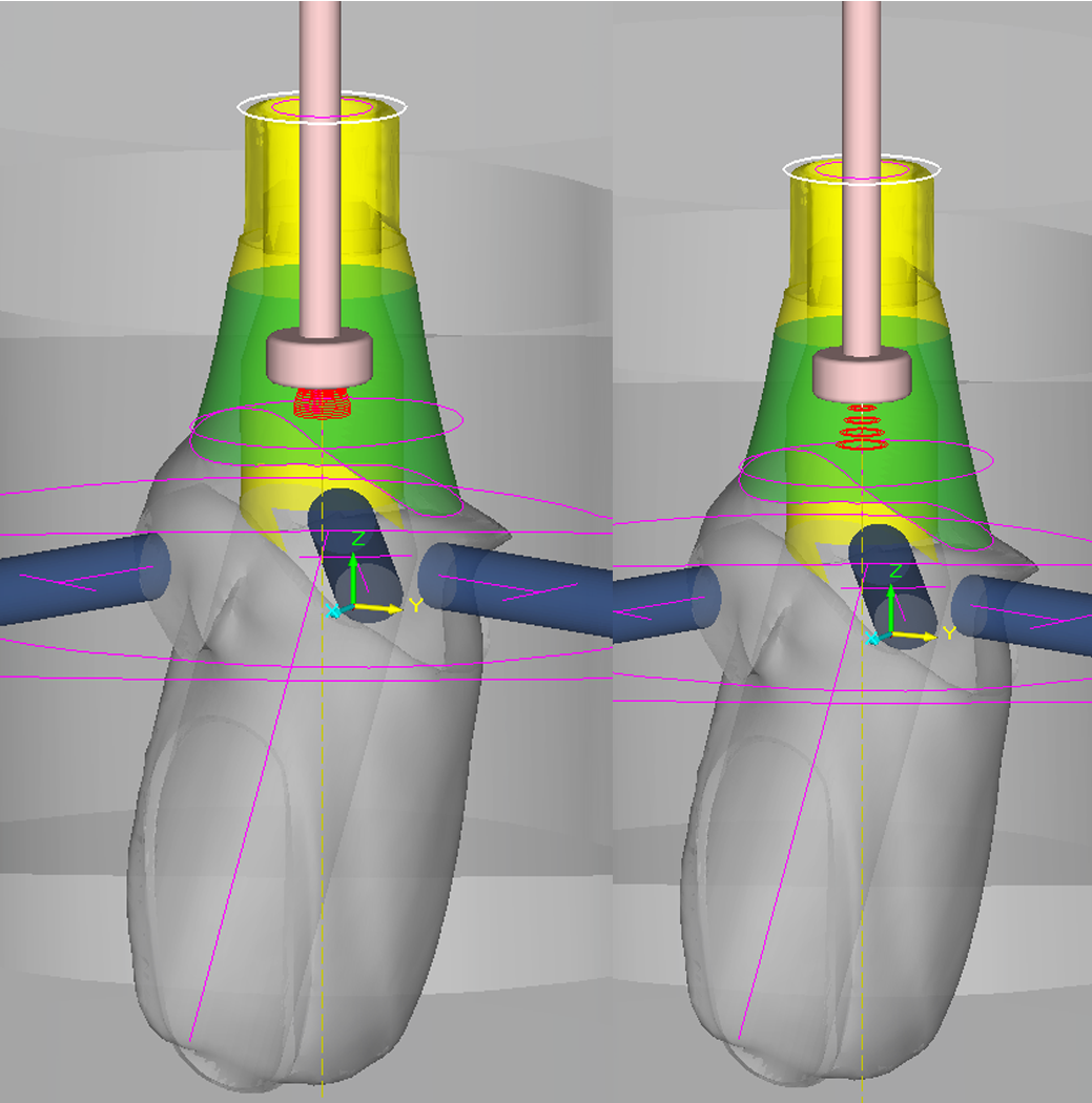 Learn how to make a cobalt chrome semi-worked product with MillBox Dental CAM Software. A practical case. 
Read the article